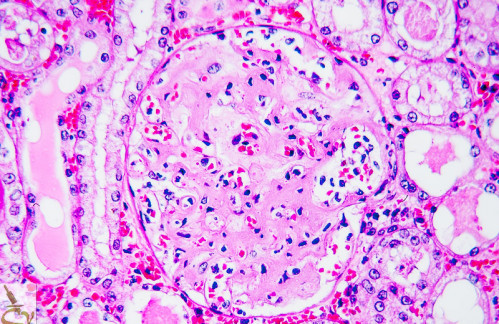 Jornadas sobre AMILOIDOSIS: lo que necesitas saber